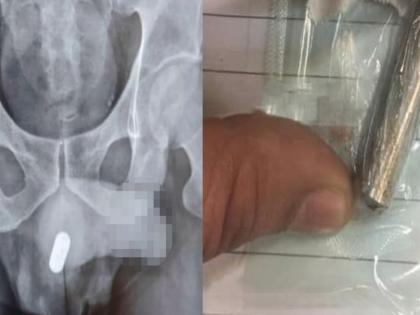 Man inserted aa battery into his private part doctor shocked | बोंबला! या व्यक्तीने प्रायव्हेट पार्टमध्ये टाकली बॅटरी, मूर्खपणा पाहून डॉक्टरही झाले हैराण