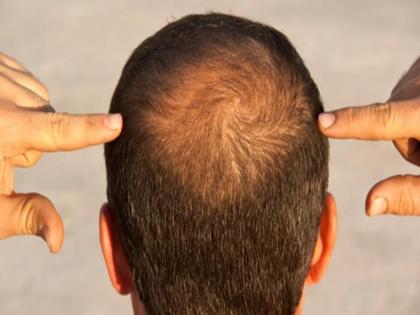 Hair Fall : Common type androgenetic alopecia causes treatment sodium | Hair Fall : एक्सपर्टनुसार हा एक पदार्थ केसगळतीचं आहे मुख्य कारण, खाता-पिताना घ्या काळजी!