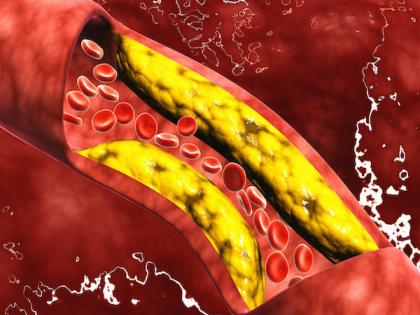 Harvard medical school suggest you must avoid these 4 foods that can cause high cholesterol | Cholesterol causing foods: रक्तात वेगाने कोलेस्ट्रॉल वाढवतात या ४ गोष्टी, हार्ट अटॅक टाळायचा असेल तर आजच सोडा