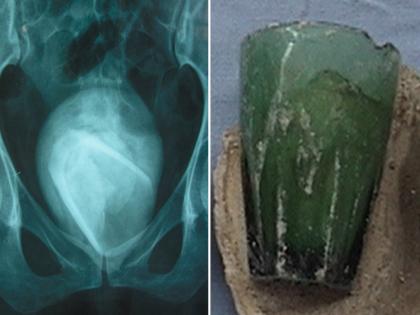 Weird News : Glass stuck in woman bladder for 4 years removed in Tunisia | महिलेच्या प्रायव्हेट पार्टमध्ये होत होती वेदना, चेकअप केल्यावर समोर आलं धक्कादायक सत्य!