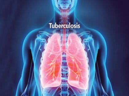 World Tuberculosis Day 2022 : Know the Symptom, causes, treatment | World Tuberculosis Day 2022 : टीबीच्या या सामान्य लक्षणांकडे करू नका दुर्लक्ष, वाढू शकतो धोका