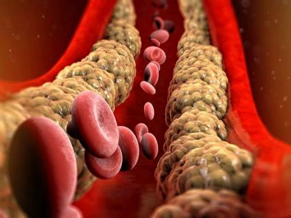 High cholesterol sign in body risk effects symptoms cramps in five areas of the body | शरीरात कोलेस्ट्रॉल वाढल्याचा हा संकेत दिसला तर वेळीच व्हा सावध, हार्ट अटॅकपासून करता येईल बचाव