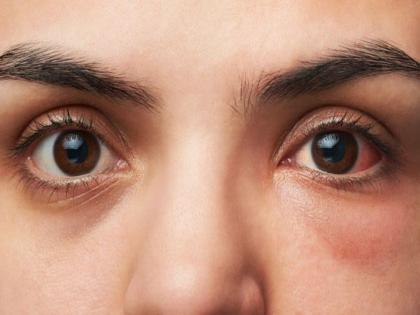 Patients of high blood pressure may have damages related to eyes | High Blood Pressure: हाय ब्लड प्रेशरच्या रूग्णांनी करू नये दुर्लक्ष, डोळ्यांचं होऊ शकतं मोठं नुकसान