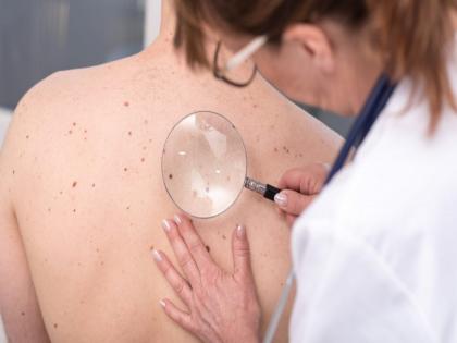 According to study men are at greater risk of skin cancer, know causes, symptoms | 'या' कॅन्सरमुळे महिलांपेक्षा पुरूषांचा जास्त होतो मृत्यू, जाणून घ्या याची कारण...