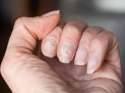 These symptoms of nails is sign of bad health | जर नखांवर दिसत असतील हे संकेत, तर वेळीच व्हा सावध; आरोग्याचं होऊ शकतं मोठं नुकसान