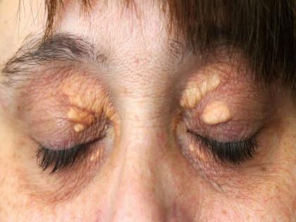 Yellow lumps around the eyes may be warning sign symptoms of high cholesterol xanthelasma | Cholesterol वाढल्यावर डोळ्यांवर दिसतात हे संकेत, दुर्लक्ष करणं पडू शकतं महागात