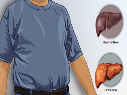 Beware of the fatty liver disease sign that may show up during night these 8 type of people are at high risk | या दोन अवयवांवर खाज येणे आहे लिव्हरच्या या गंभीर आजाराचा संकेत, या 8 लोकांना राहतो जास्त धोका