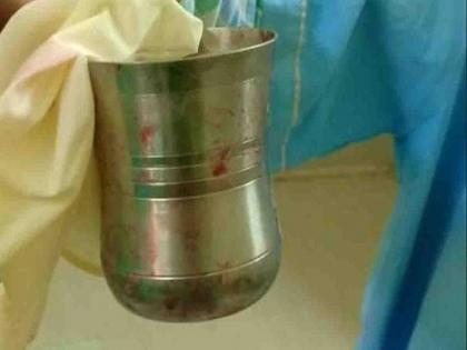 OMG! Doctor removed steel glass from stomach of Jaunpur man | डॉक्टरांनी रूग्णाच्या पोटातून काढला स्टीलचा मोठा ग्लास, आत कसा गेला वाचाल तर चक्रावून जाल!