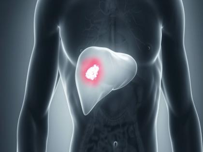 Liver Cancer causes and treatment how to avoid liver cancer | Liver Cancer : किचनमधील या चुकीमुळे तुम्हाला होऊ शकतो लिव्हर कॅन्सरचा धोका, वेळीच व्हा सावध!