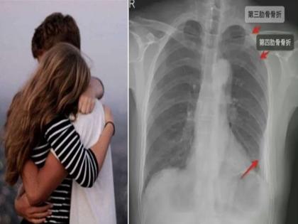 Chinese woman sued her coworker after he broke three of her ribs by hugging too tightly | तरूणाने तरूणीला दिली अशी झप्पी, मोडली छातीची तीन हाडे; केस करून मागितले इतके लाख रूपये