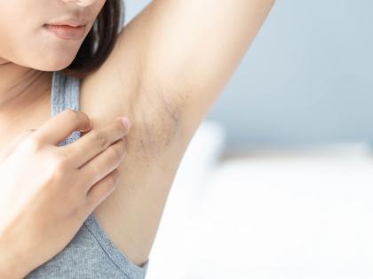 Beauty Tips : Causes of black underarms natural treatment get white soft and silky underarms | या घरगुती उपायांनी दूर करा अंडरआर्ममधील काळे डाग, पुन्हा होणार नाही ही समस्या!