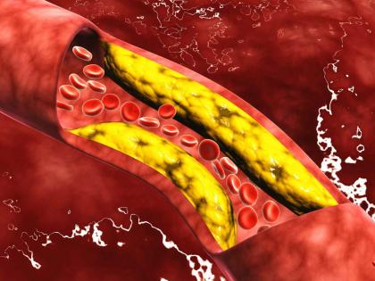 High cholesterol : Soaked moong dal as high cholesterol lowering diet, you should know this | High Cholesterol कमी करण्यासाठी रामबाण उपाय आहे ही डाळ, जाणून घ्या कसं करावं सेवन!