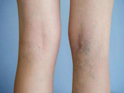 Ayurveda doctor Rekha explain what is varicose veins causes, symptoms and ayurvedic treatment | पायांच्या नसा फुगलेल्या आणि निळ्या दिसतात का? असू शकतं हे गंभीर कारण...