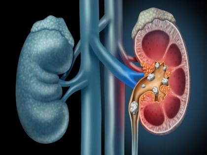 Sign of kidney Damage : These are the symptoms of kidney disease and damage | शरीरात दिसतील हे बदल तर वेळीच व्हा सावध, Kidney Damage चे असू शकतात संकेत