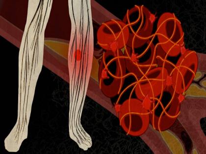 Blood Clotting Sign: What are the symptoms if a blood clot in body, Here are the 5 way to catch it | तुम्हाला कळणारही नाही तुमच्या नसांमध्ये तयार होत आहेत रक्ताच्या गाठी, 5 लक्षणांकडे करू नका दुर्लक्ष