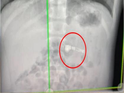 Women ate apple ipod thinking it as a medicine doctor shock after seeing x-ray | औषध समजून महिलेने गिळला Apple आयपॉड, पोटातून येऊ लागला होता आवाज...