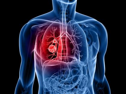 Lung cancer risk and its treatments | फुफ्फुसांचा कर्करोग आणि त्यावरील उपचारांमध्ये घडून आलेला विकास