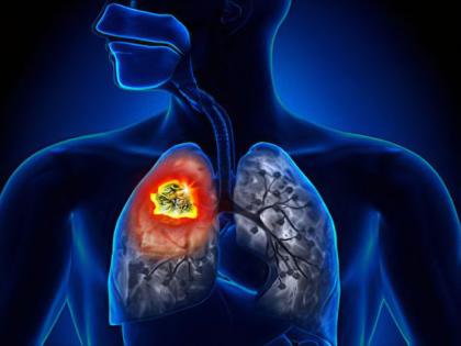 10 in every 100 patients with lung cancer; Passive smoking is also dangerous | प्रत्येक १०० मध्ये १० रुग्ण फुप्फुसाच्या कॅन्सरचे; ‘पॅसिव्ह स्मोकिंग’ही धोकादायकच