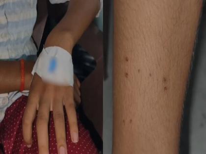 In UP A snake followed a 15-year-old girl; bit her 6 times in 1 month, leaving marks on her leg each time | १५ वर्षीय मुलीच्या मागेच लागला साप; १ महिन्यात ६ वेळा चावला, प्रत्येकवेळी पायावर खुणा सोडल्या In UP A snake followed a 15-year-old girl; bit her 6 times in 1 month, leaving marks on her leg each time | १५ वर्षीय मुलीच्या मागेच लागला साप; १ महिन्यात ६ वेळा चावला, प्रत्येकवेळी पायावर खुणा सोडल्या