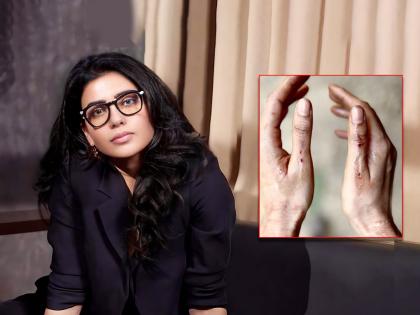 Samantha ruth prabhu injured on the sets of citadel | Samantha Ruth Prabhu:शूटिंग दरम्यान अभिनेत्री झाली जखमी, फोटो शअर करत दिली माहिती