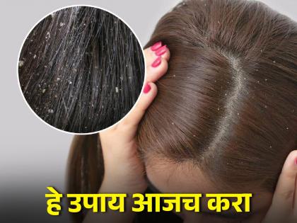 itchy scalp causes treatment and preventation know about how to get relief | वारंवार डोके खाजवताय; हे कारण तर नाही ना