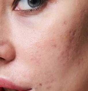 मुरूम फोडले आणि चेहऱ्यावर खड्डे पडलेत? पाहा 'हे' खड्डे भरण्यासाठी काय आहेत घरगुती उपाय