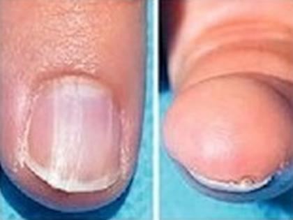 Cancer will be known from the color of nails now; New research done by researchers in America; Identify the bulge on the nail | आता नखांच्या रंगावरून कळणार कॅन्सर; अमेरिकेतील संशोधकांनी केले नवे संशोधन; नखांवरील फुगवटा ओळखा