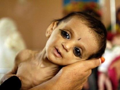 Make sure no child is Malnutrition; Court to Maharashtra Government | एकही मूल कुपोषणाने बळी जाणार नाही याची खात्री करा; उच्च न्यायालयाची राज्य सरकारला तंबी