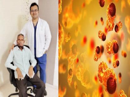 80 years old, or 80 years young? Grandfather beat as many as two types of cancer | 80 साल के बुढे, या 80 साल के जवान? तब्बल दोन प्रकारच्या कर्करोगांना हरवले आजोबांनी