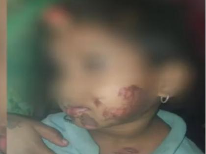 Step mother slapped daughter, shocking incident in Kolhapur district | सावत्र आईने मुलीला उलाथण्याने दिले चटके, कोल्हापूर जिल्ह्यात घडली नात्याला काळीमा फासणारी घटना