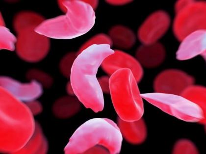 Modern treatment for sickle cell and thalassemia patients | सिकलसेल, थॅलेसेमिया रुग्णांना मिळणार आधुनिक उपचार