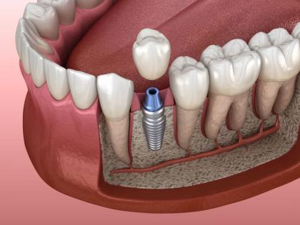 Woman dies after artificial teeth get stuck in esophagus | अन्ननलिकेत कृत्रिम दात अडकल्याने महिलेचा मृत्यू Woman dies after artificial teeth get stuck in esophagus | अन्ननलिकेत कृत्रिम दात अडकल्याने महिलेचा मृत्यू