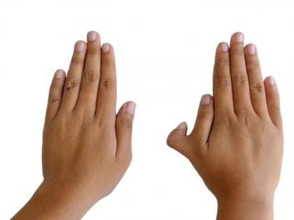 people with six fingers are very lucky | काय असतं सहा बोटे असलेल्या व्यक्तींच्या नशिबात? समुद्रशास्त्र सांगते...