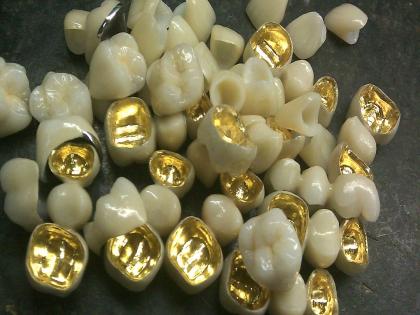 Don't want gold teeth Demand for PSM teeth increased | सोन्याचे दात नको रे बाबा; पीएसएम दातांची मागणी वाढली