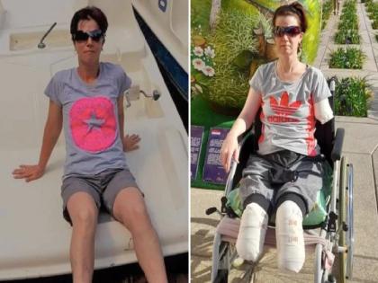 Woman, 39, loses three limbs in 11 days after going to hospital with TUMMY pain | बापरे! पोटात दुखतंय म्हणून हॉस्पिटलला पोहचली महिला; डॉक्टरांनी तपासताच ११ दिवसांनी हात-पाय कापले