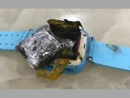 Smartwatch explodes on the wrist third degree burn  | मनगटावरील Smartwatch चा स्फोट; चार वर्षाच्या मुलीच्या हाताला थर्ड डिग्री बर्न 