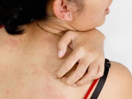 Health : Facts about psoriasis you should know | सोरायसिसबाबत ५ महत्वाच्या गोष्टी, काय आहे ही समस्या?