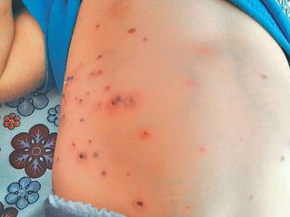 Scrub Typhus to two-year-old girl | दोन वर्षाच्या चिमुकलीला स्क्रब टायफस