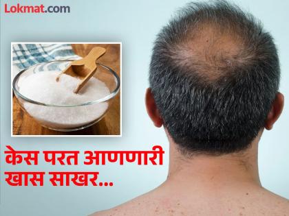 Men suffering from baldness study claims sugar grains can regrow hair | जगभरातील पुरूष टक्कल पडण्याला वैतागले, रिसर्चचा दावा साखरेच्या दाण्यांमुळे परत येऊ शकतात केस!