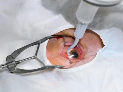 Surgical retinal surgery closed in Mayo, Medical | मेयो, मेडिकलमध्ये सर्जिकल रेटीनाच्या शस्त्रक्रिया बंद