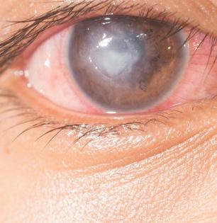 बाप रे! ऐन तारुण्यात अवघ्या तिशीतच तरुणांना येतंय अंध्यत्व, कॉर्नियल ब्लाइंडनेसची पाहा लक्षणं..