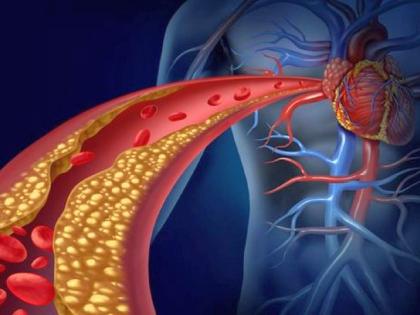 single injection in a month instead of daily pill for cholesterol | कोलेस्ट्रॉलवर रोजच्या गोळीपेक्षा आता महिन्यातून एकच इंजेक्शन