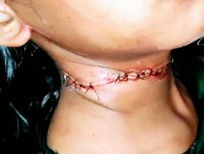 little girl's throat was cut by thread of kite; It took as many as 26 stitches | काही कळायच्या आत 'त्या' चिमुकलीचा गळा कापला गेला; लागले तब्बल २६ टाके