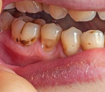 Dental Care: टार्टर आणि प्लाक दातांचे मुख्य शत्रू, करू शकतात गंभीर नुकसान; वेळीच घ्या 'ही' काळजी 