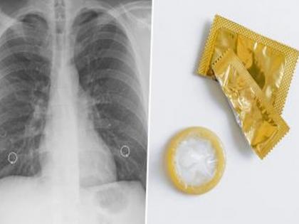 Shocking PICS! Woman thinks she has TB, but it was Condom stuck in her lung