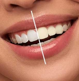 जेवण झालं की लगेच चावून चावून खा ‘या’ गोष्टी, दाताला कीड लागून वेदना होणं टळेल