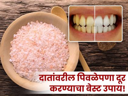 American Doctor told best home remedy to remove plaque from teeth | दातांवरील पिवळेपणा मूळापासून होईल दूर, डॉक्टरांनी सांगितला एक खास घरगुती उपाय!