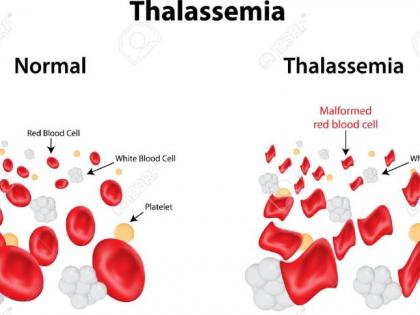 Thalassemia deaths of 1 lakh patients annually | दरवर्षी थॅलेसेमियाच्या १ लाख रुग्णांचा मृत्यू