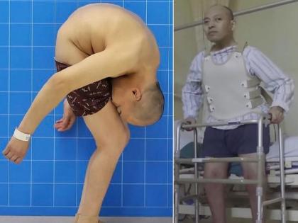 China folding man can finally stand straight after life changing surgery? | तब्बल २८ वर्षांनी उभा राहीला ‘हा’ व्यक्ती, जाणून घ्या या आजाराविषयी 