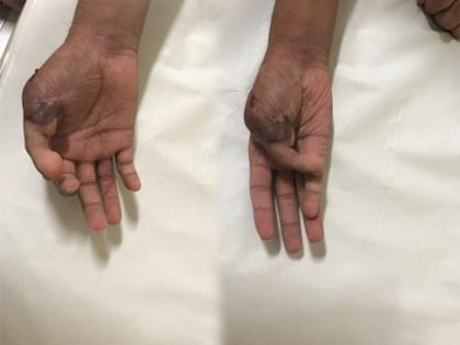 A 35-year-old person got the job back from thumb transplant surgery | अंगठा प्रत्यारोपण शस्त्रक्रियेने 35 वर्षीय व्यक्तीला परत मिळाली नोकरी